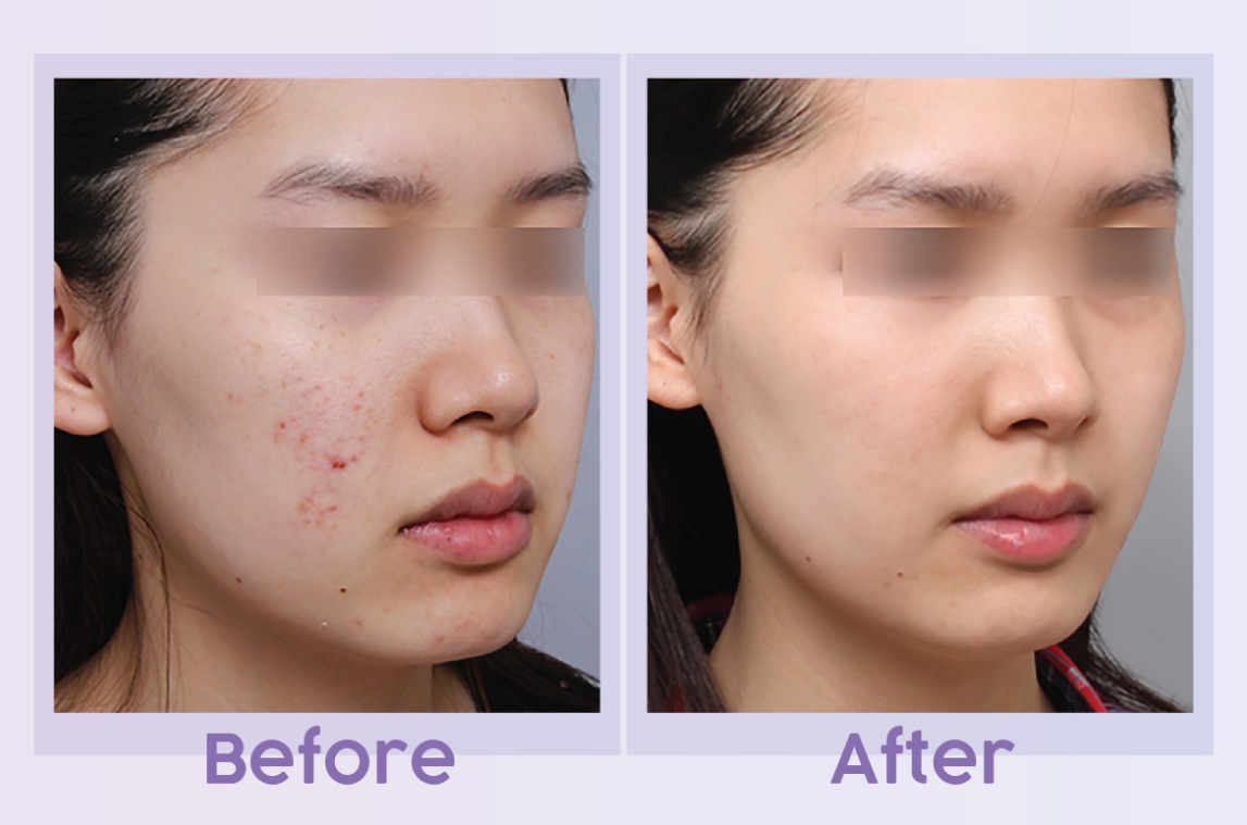 PRP before and after result 4